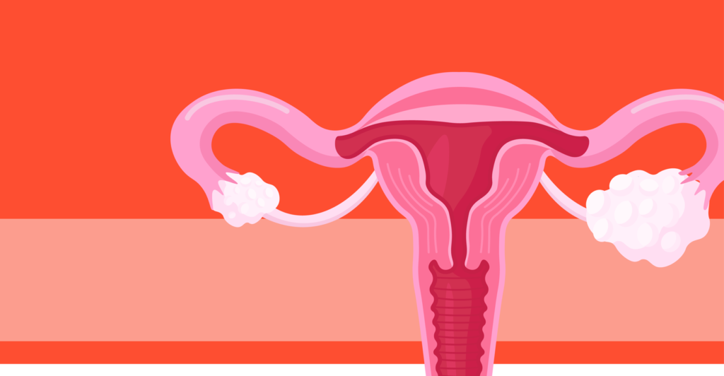 How PCOS Affects Your Body