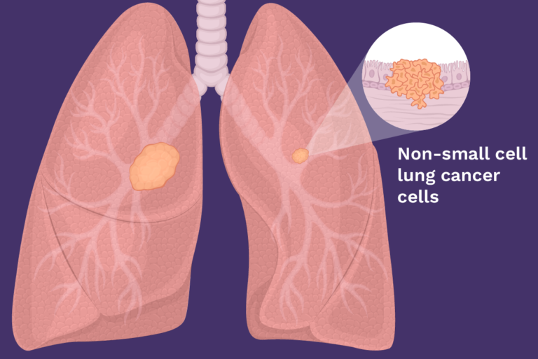 Non-small cell lung cancer (NSCLC)