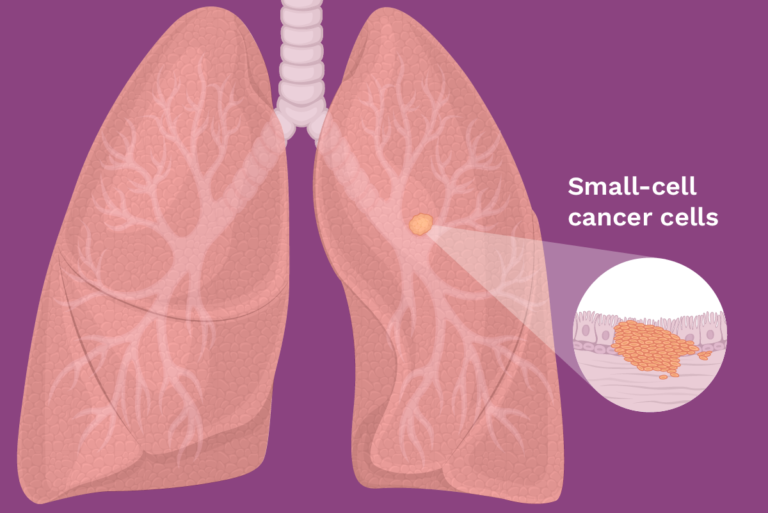 2. Small cell lung cancer (SCLC)