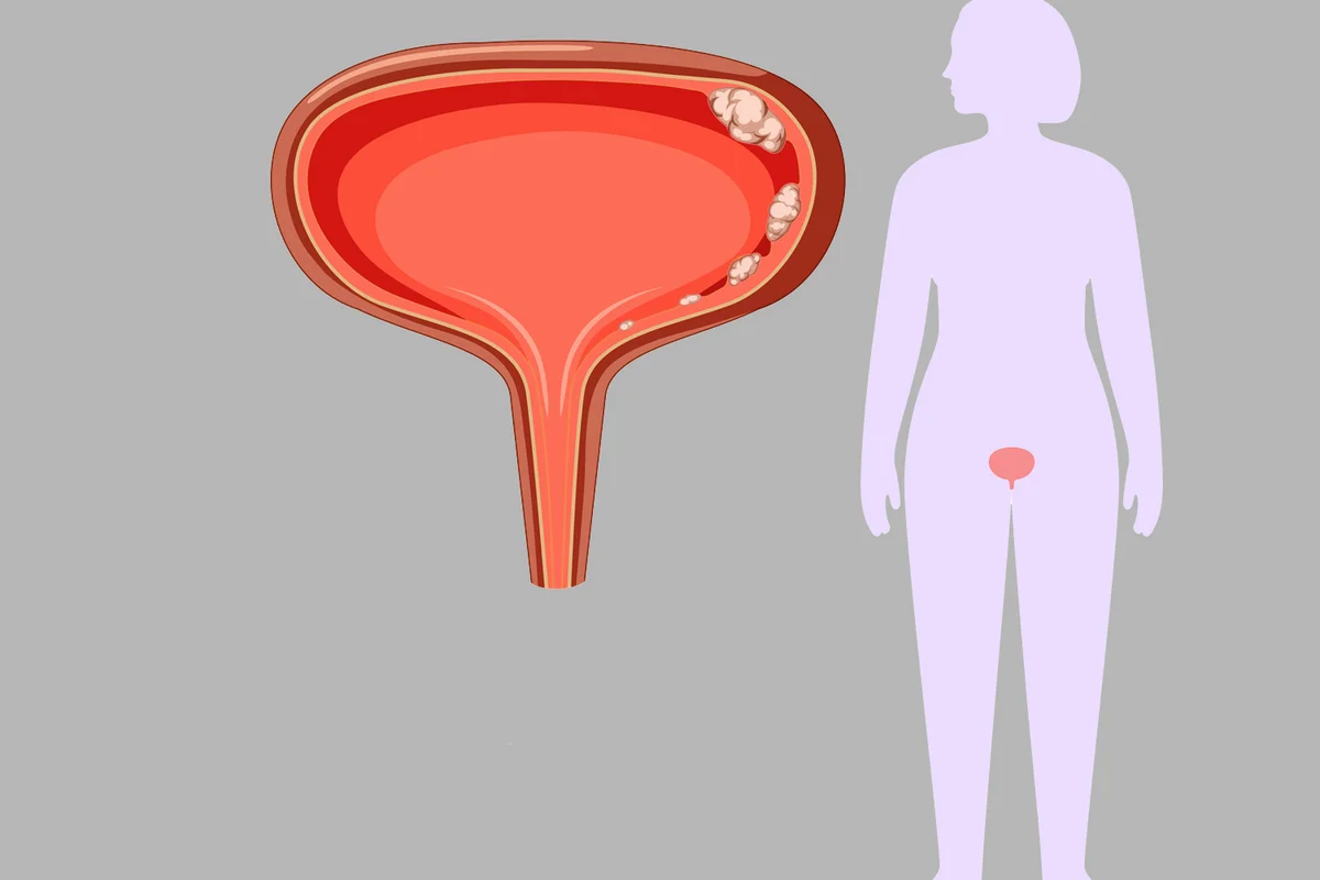 living with bladder cancer